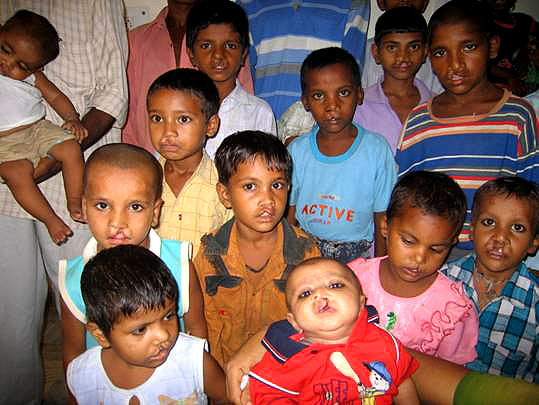 Children with cleft lip and palate, at Subharati Institute of Medical Science, Meerut, 2006